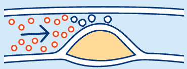 plague (fatty tissue)